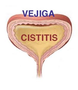 Cistitis Cómo Combatirla