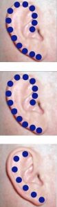 Perder Peso con Puntos en la Oreja