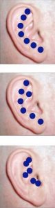 Perder Peso con Puntos en la Oreja